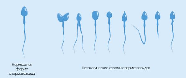 патологические формы сперматозоидов