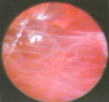 синехии в полости матки при гистероскопии