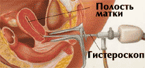 Офисная гистероскопия матки Офисная гистероскопия матки