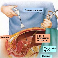 Лапароскопия при бесплодии 1 .png Лапароскопия при бесплодии 1 .png