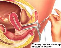 Процедура внутриматочной инсеминации