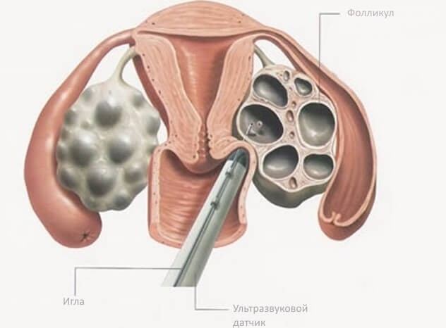 Как проходит процедура пункции фолликулов при ЭКО