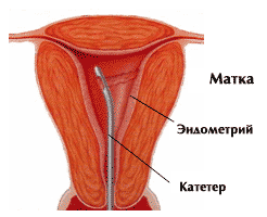 Биопсия эндометрия