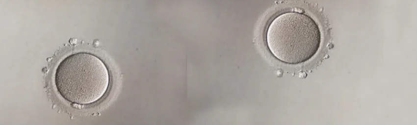 ЭКО с донорской яйцеклеткой