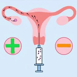 Искусственная инсеминация: плюсы и минусы